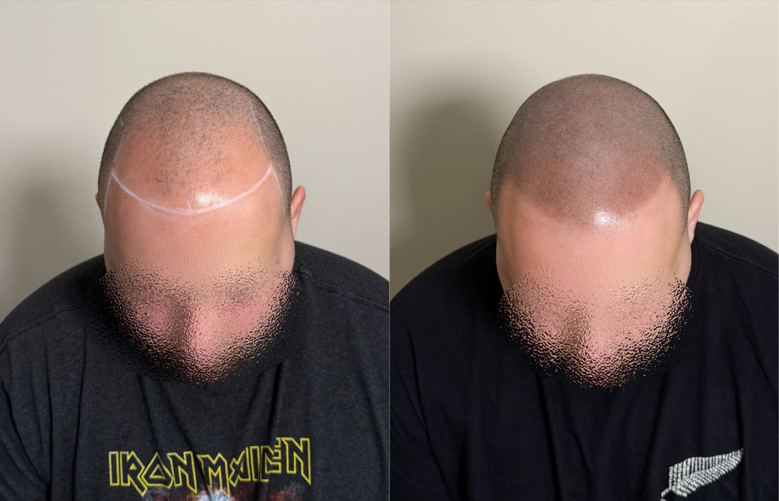 Shaved look SMP portfolio 5